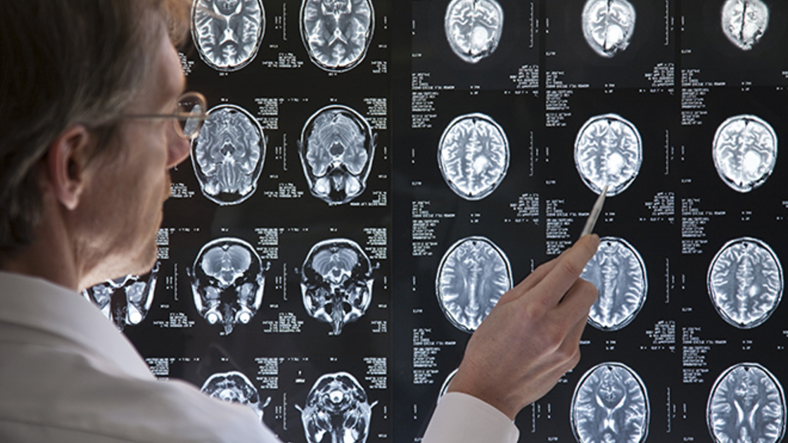 Doctor studying an MRI scan of the Brain